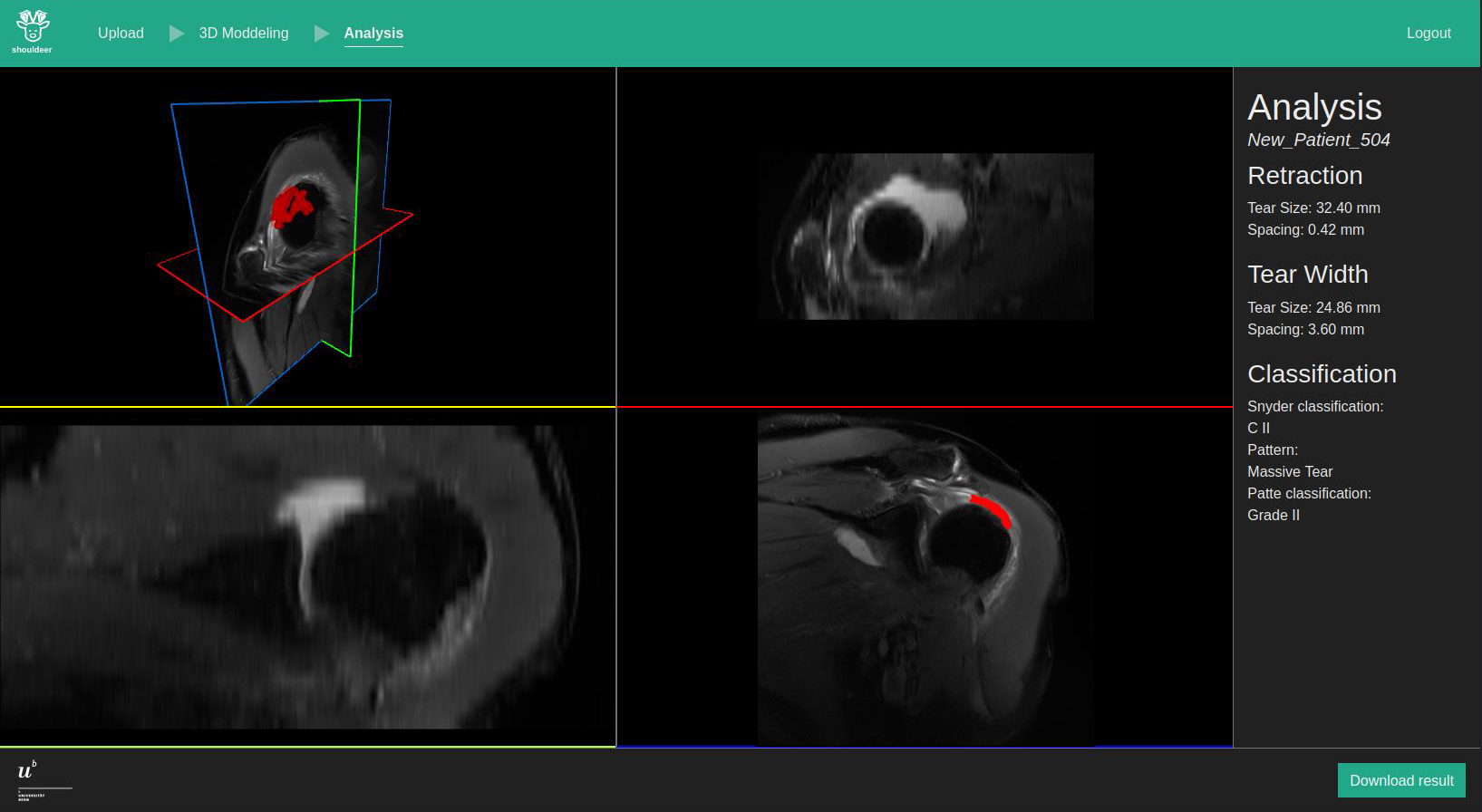 Our software showing the segmentation of a torn tendon from MRI data